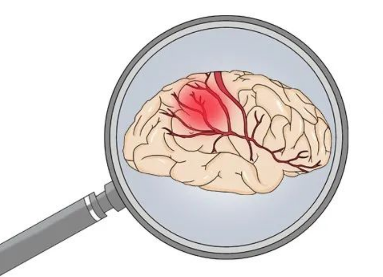 原来“脑溢血”离你这么近！超过三十岁的尤其要注意！